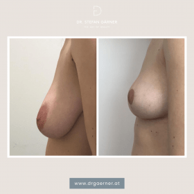 Breasts by Dr. Gärner