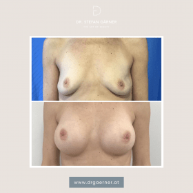 Breasts by Dr. Gärner